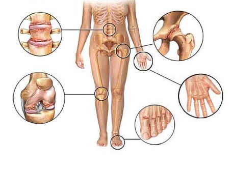 Остеоартроз поражает различные суставы.