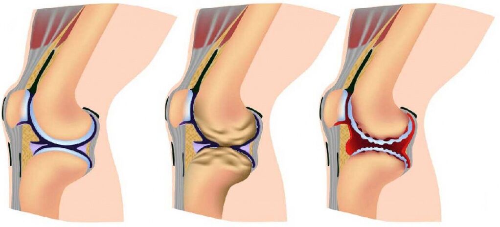 Здоровый сустав, пораженный артрозом